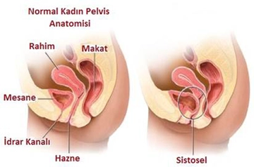 İdrar Torbası Sarkması Belirtileri ve Tedavisi