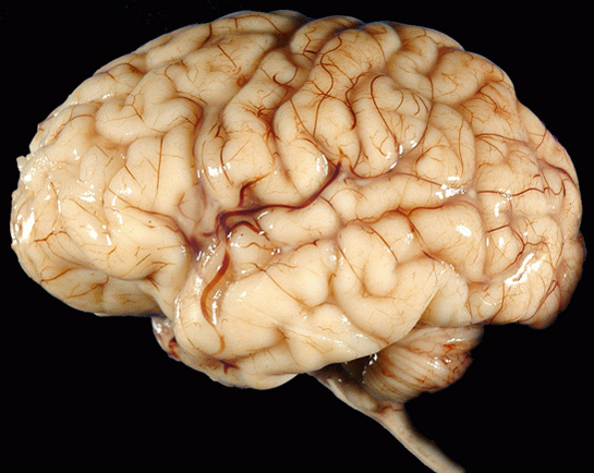 Beyin Sarkması Belirtileri ve Tedavisi