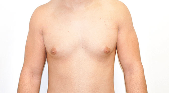 Erkekte Göğüs Sarkması Belirtileri ve Tedavisi