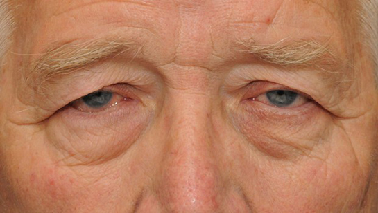 Göz Kapağı Sarkması Belirtileri ve Tedavisi