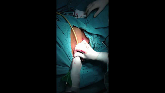 İdrar Kesesi Sarkması Ameliyatı Riskleri ve Sonrası